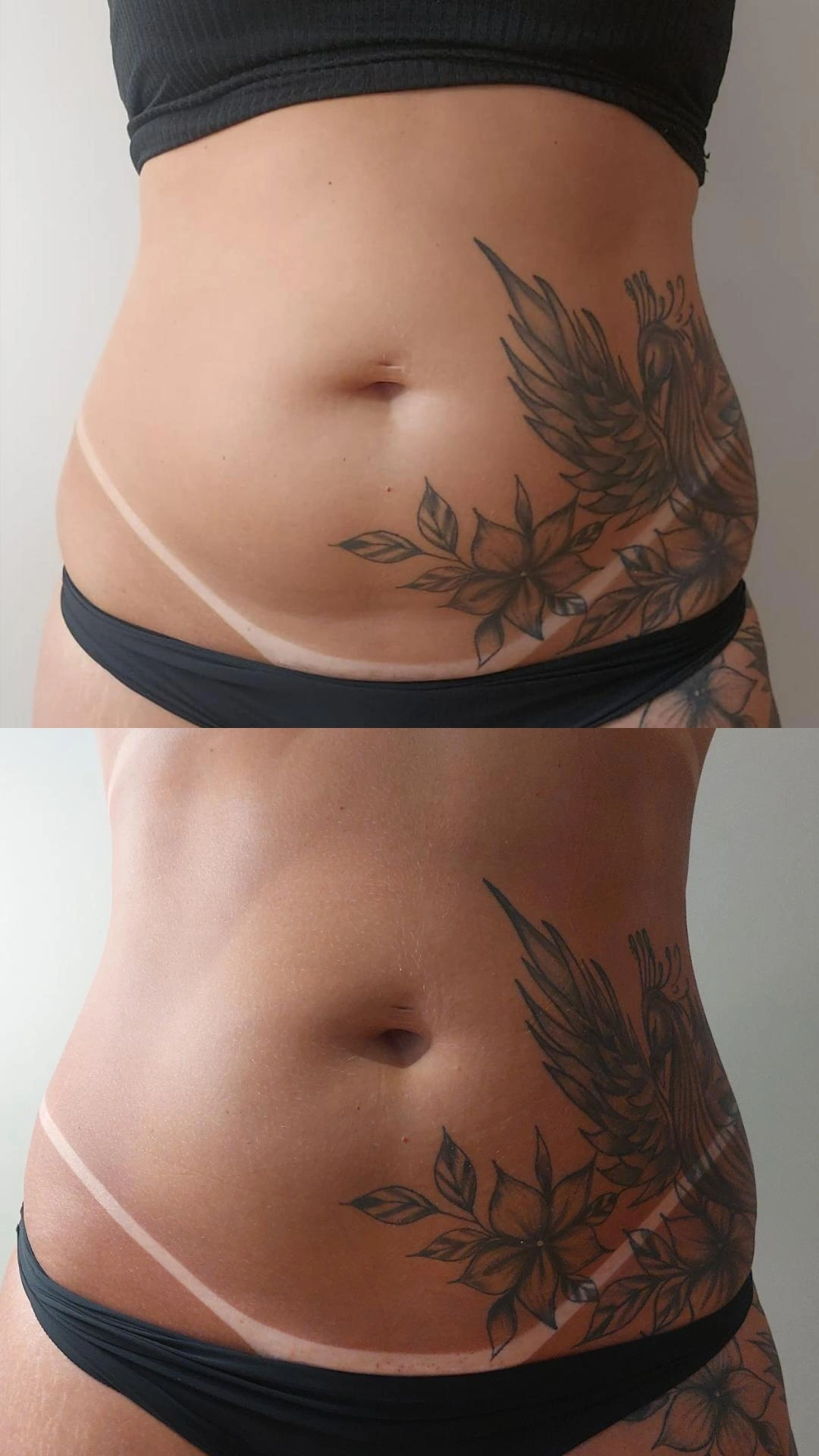 Antes e depois corporal Dermaled