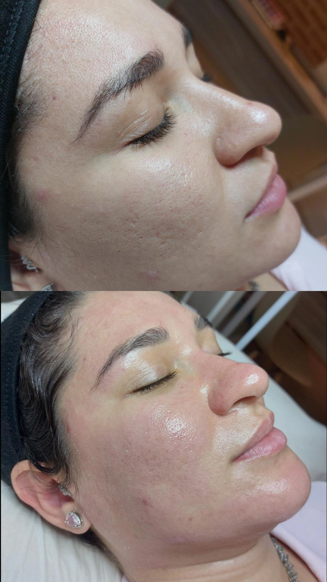 Tratamento facial Dermaled