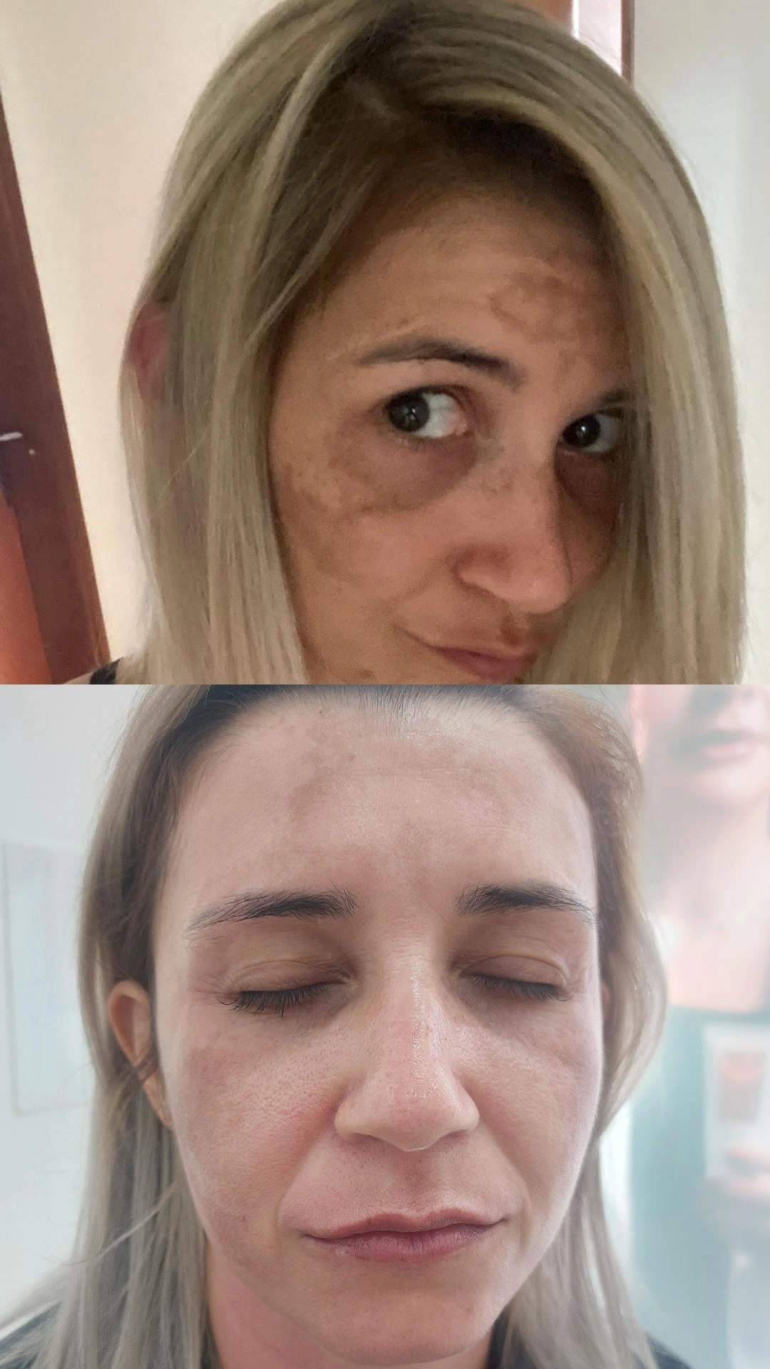 Melhora na pele após tratamento